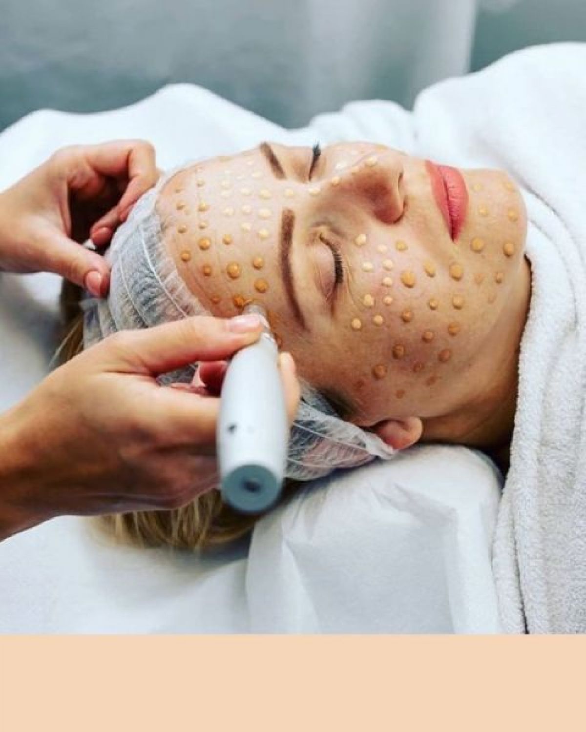 Microneedling/BB GLOW à Rennes (35) Par Glade - Estheca