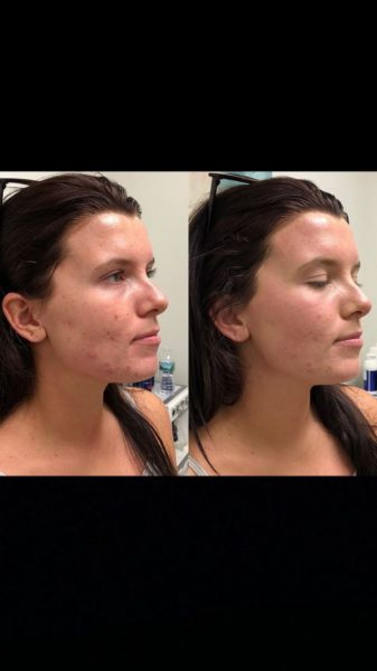 Microneedling contre les traces d'Acné et taches à Lille (59) Par Véronique - Estheca