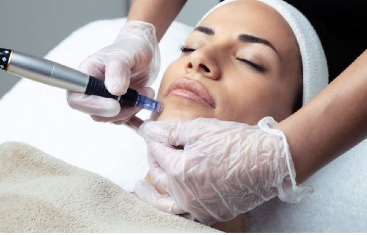 Microneedling(traces d'acnés, anti âge, anti taches ...) à Villiers-le-Bel (95) Par Sania - Estheca