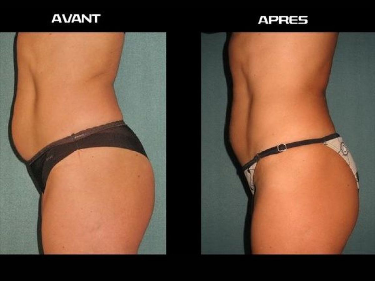 Lipocavitation à Valenciennes (59) Par Stacie - Estheca