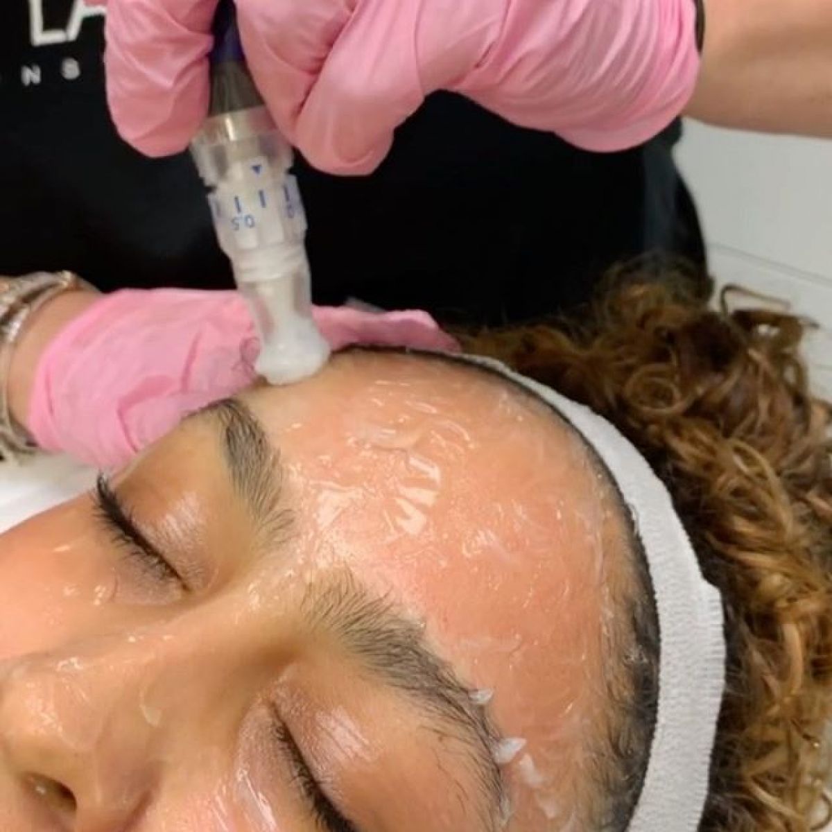 MicroNeedling BB Glow à Orvault (44) Par Sarah - Estheca