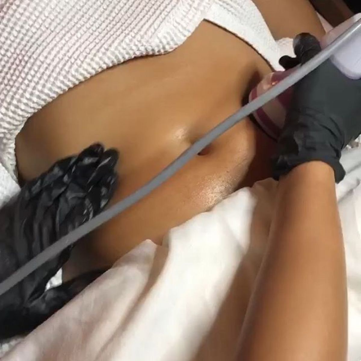 Radio fréquence / Lipocavitation à Asnières-sur-Seine (92) Par Caroline - Estheca