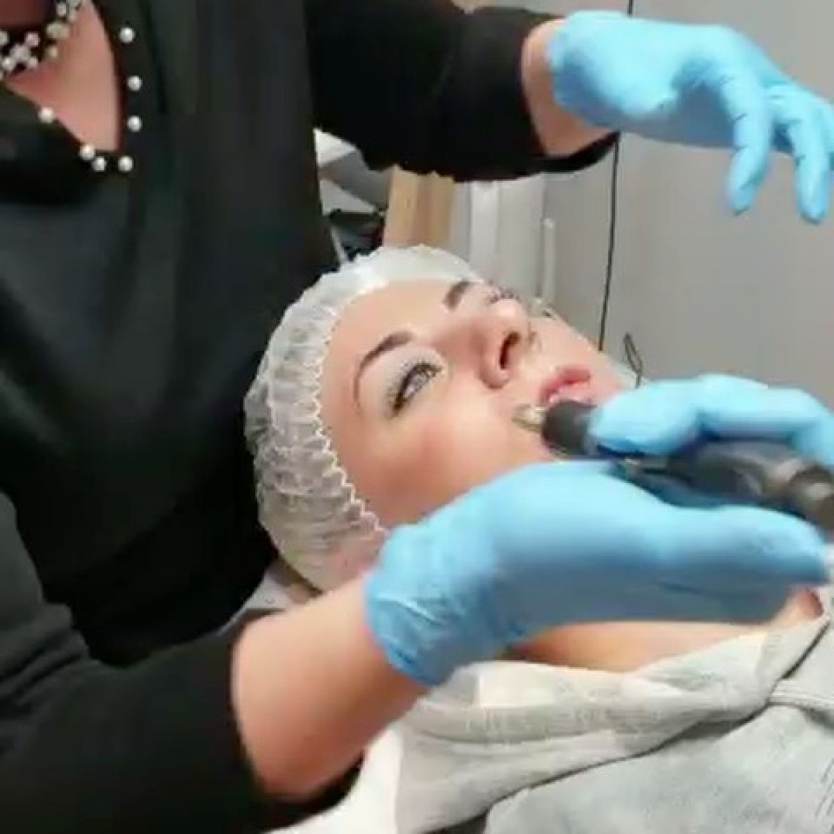Hyaluron pen lèvres et rides à Corbeil-Essonnes (91) Par Manel - Estheca