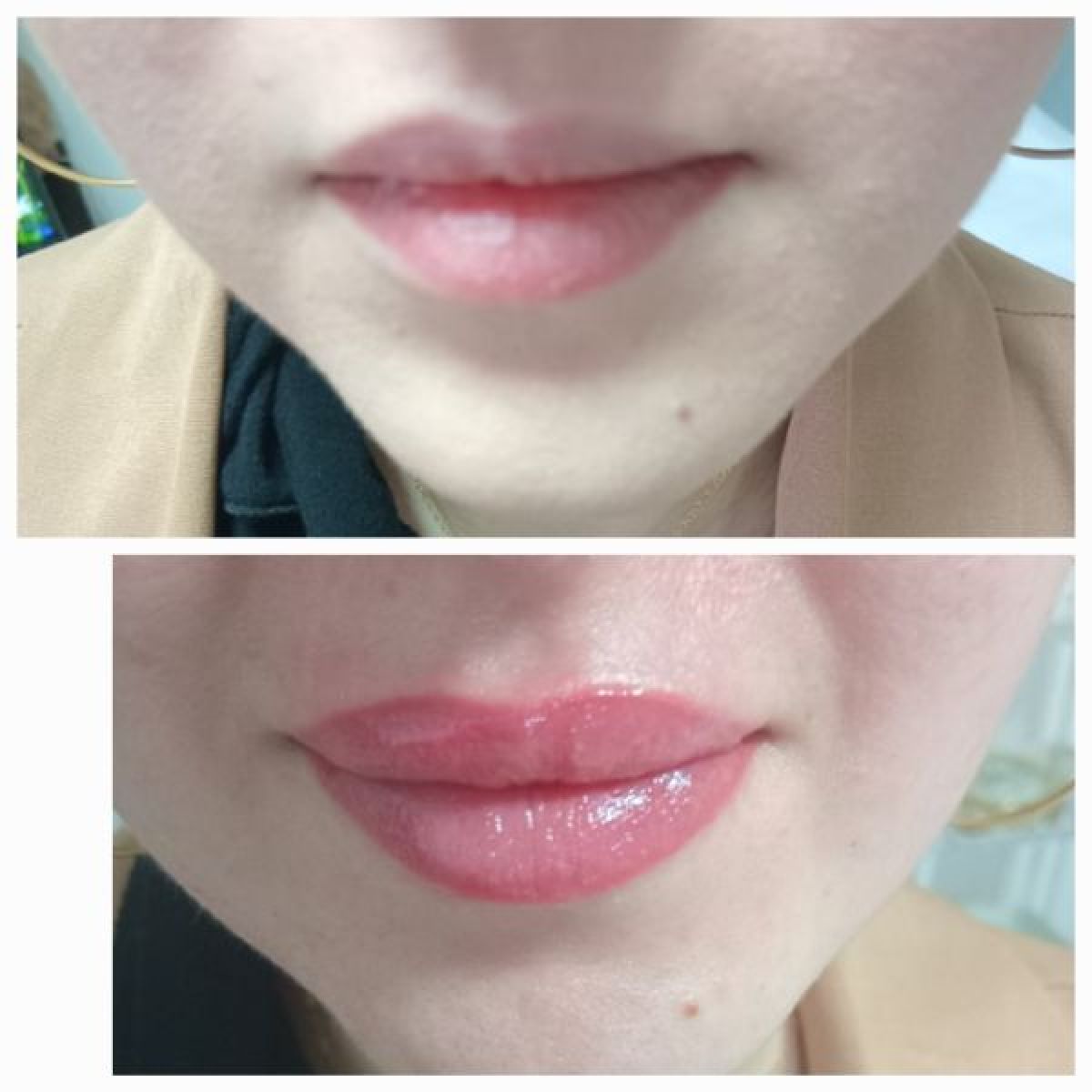 Augmentation des lèvres sans injection/ graisse menton à Sucy-en-Brie (94) Par Rafika - Estheca
