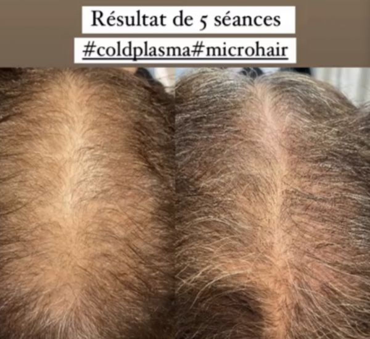 Micro Hair à Blois (41) Par Ayse - Estheca