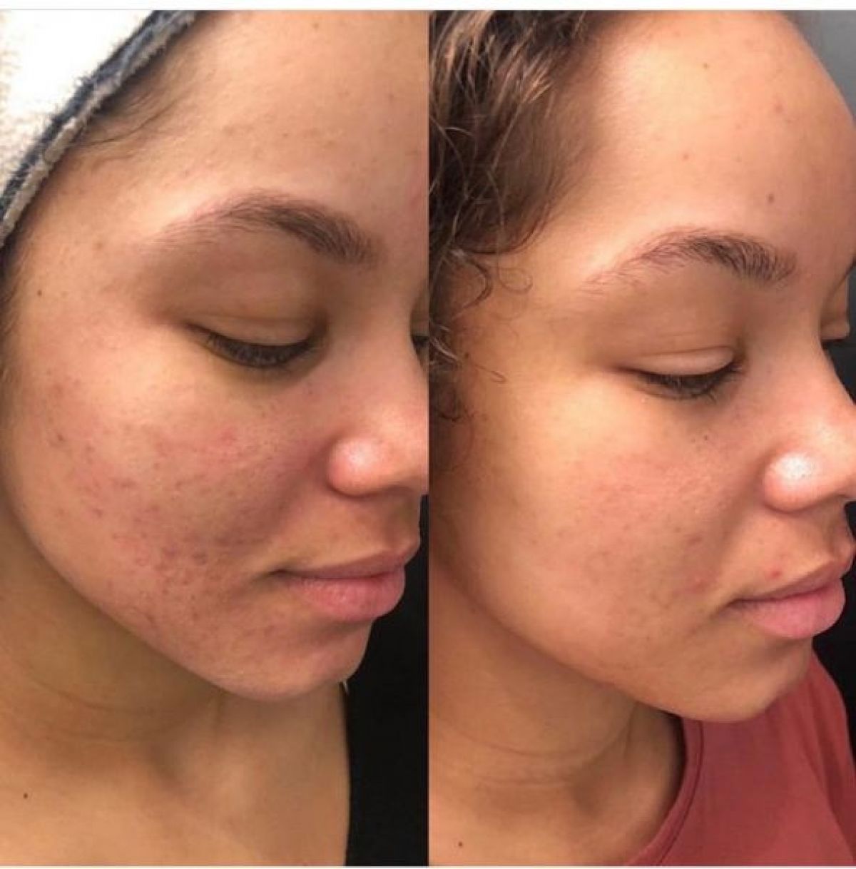 Microneedling / BB Glow  à Croix (59) Par Julie - Estheca