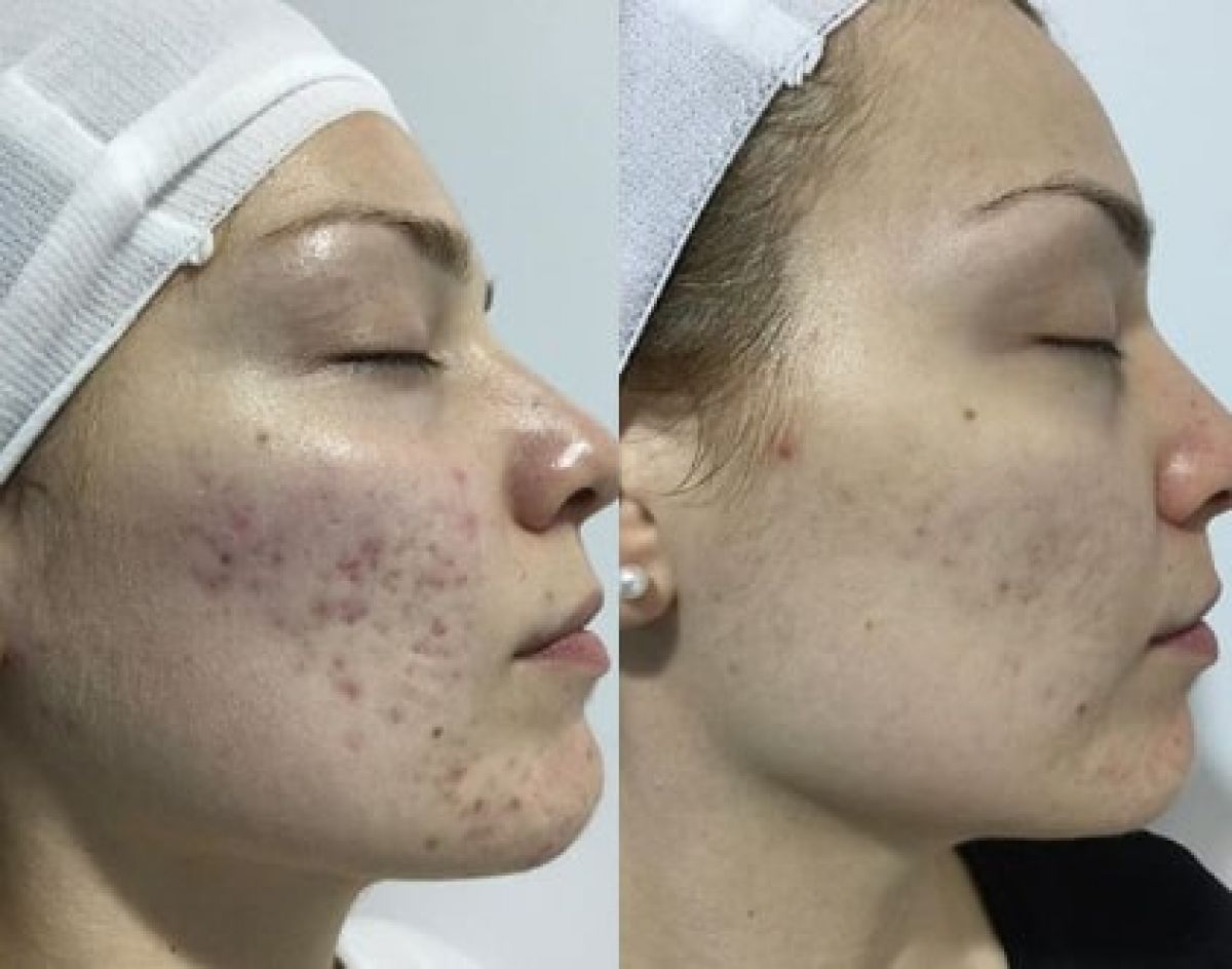 Microneedling/BB GLOW à Orange (84) Par Kelly - Estheca