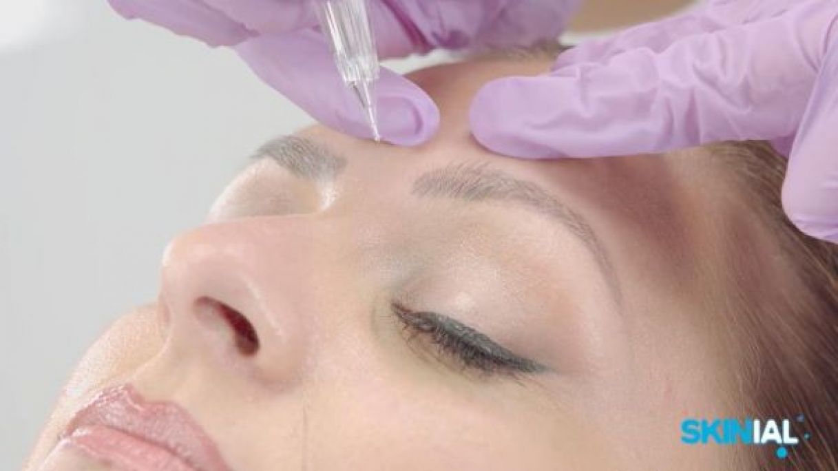 Détatouage sans laser Skinial à Strasbourg (67) Par Huyen - Estheca