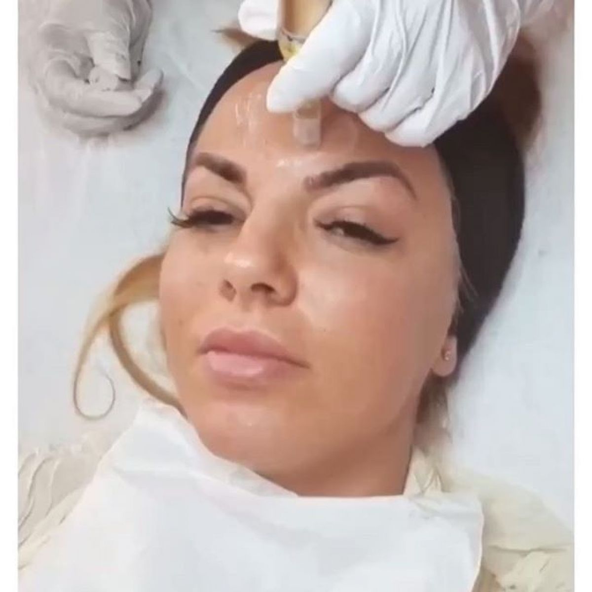 MicroNeedling BBGlow à Nanterre (92) Par Émilie - Estheca