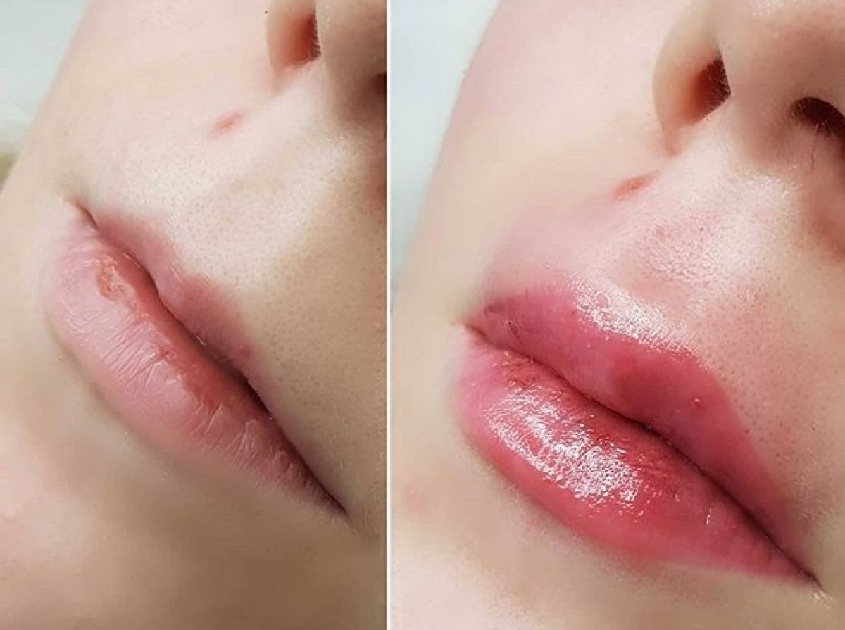 Augmentation des lèvres sans injection à Sucy-en-Brie (94) Par Rafika - Estheca
