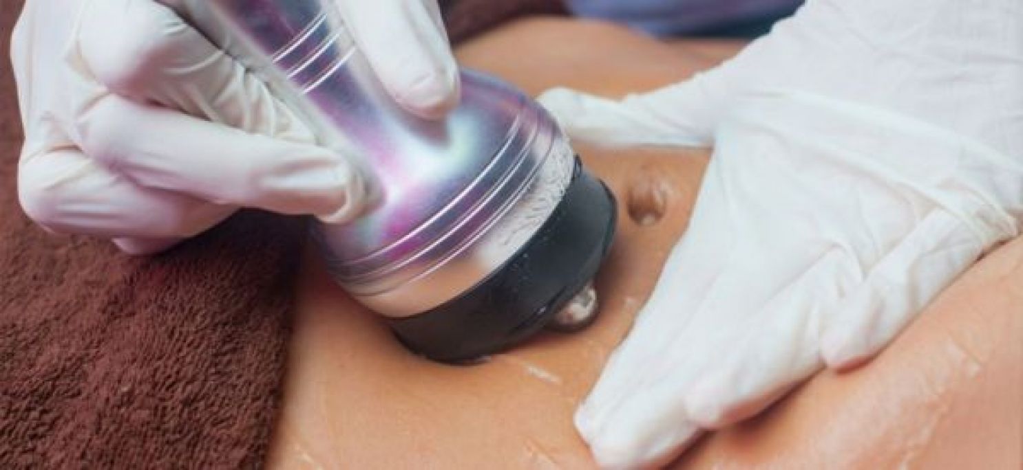 Radio fréquence et Lipocavitation à Souffelweyersheim (67) Par Claire - Estheca