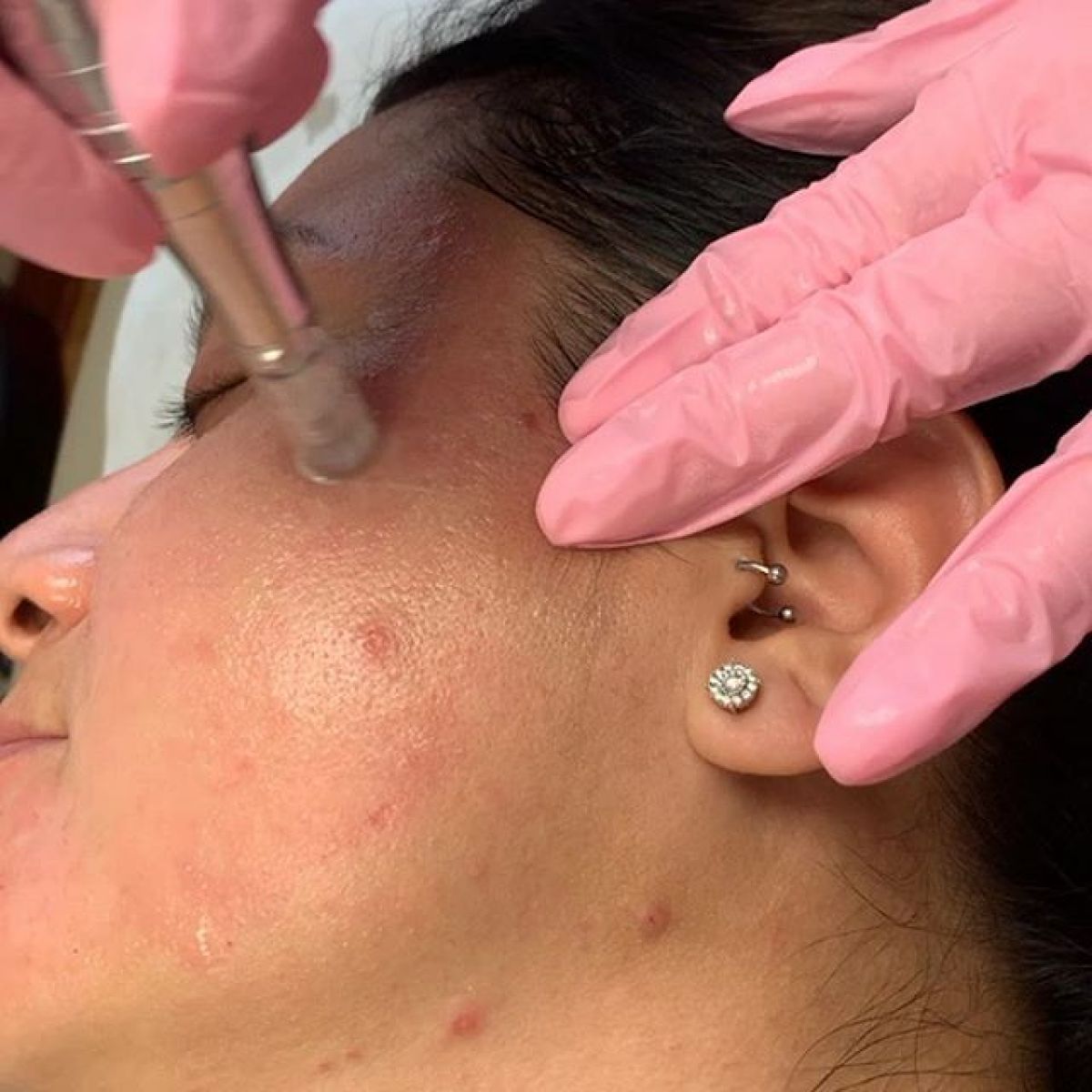 MicroNeedling BB Glow à Saint-Maur-des-Fossés (94) Par Céline - Estheca