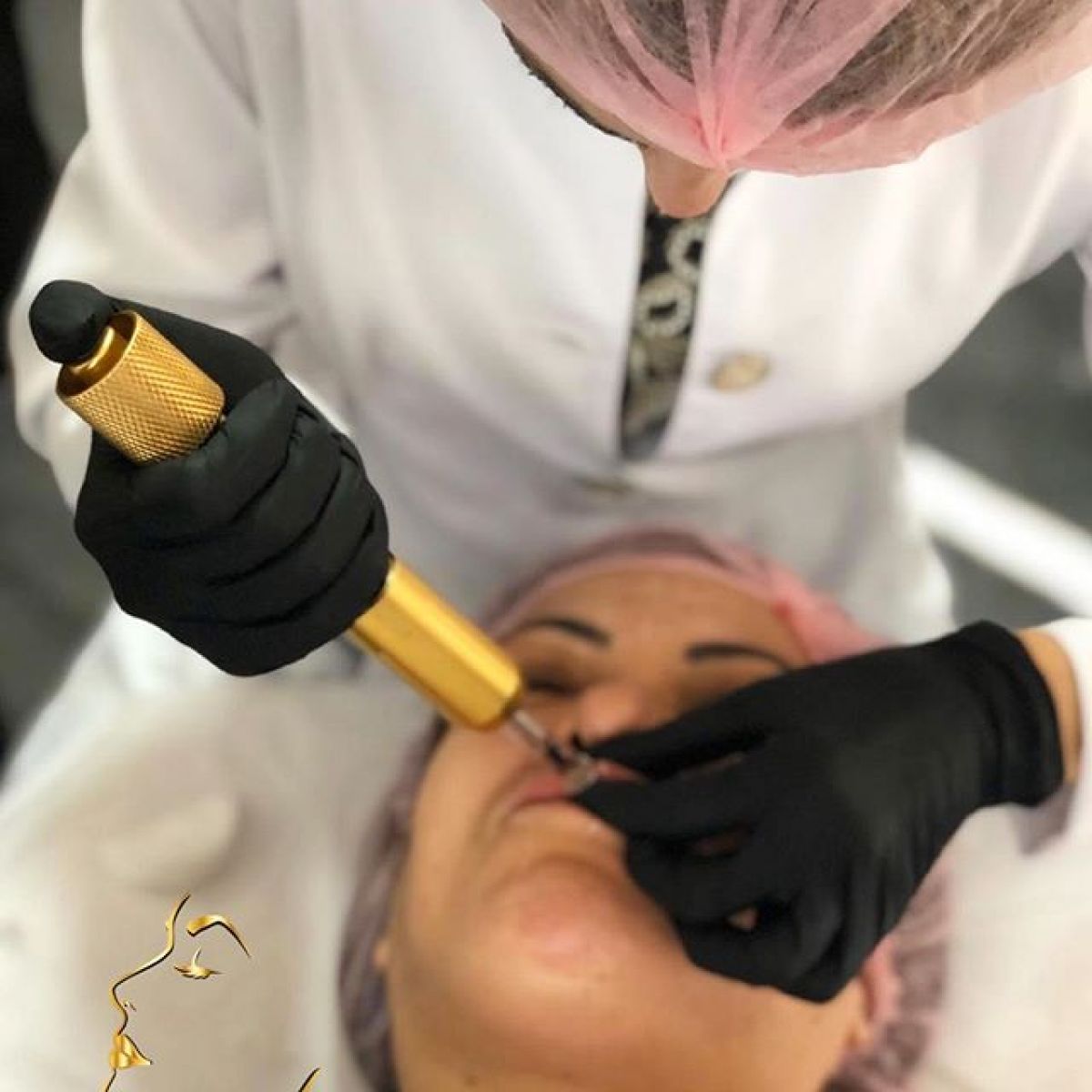 Hyaluron pen lèvres et rides à Rosny-sous-Bois (93) Par Céline - Estheca