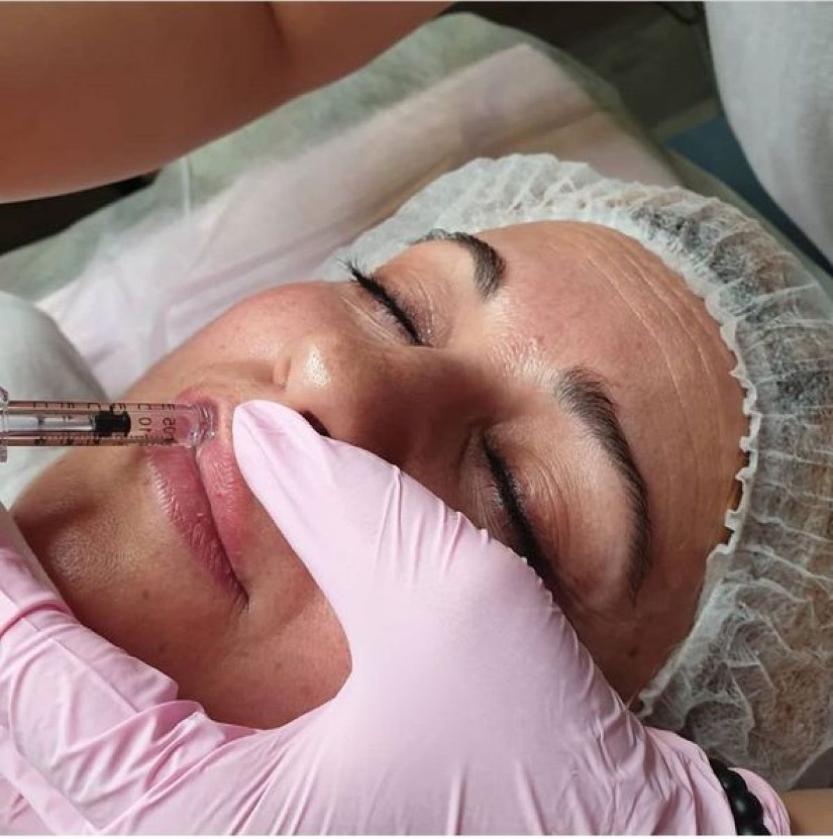 Hyaluron pen à Annemasse (74) Par Maud - Estheca