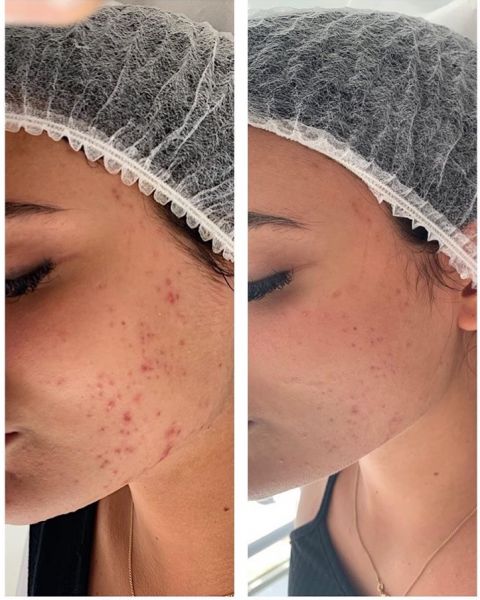 À Cholet | Microneedling BB GLOW | Les meilleures esthéticiennes