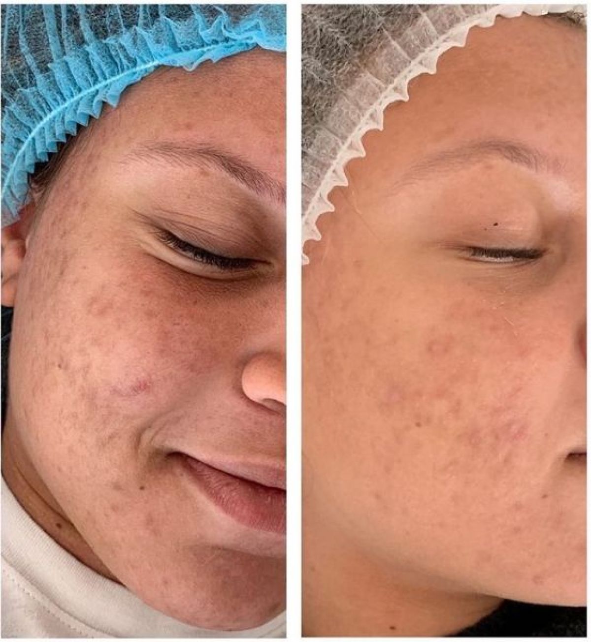 Microneedling BB GLOW à Tours (37) Par Anais - Estheca