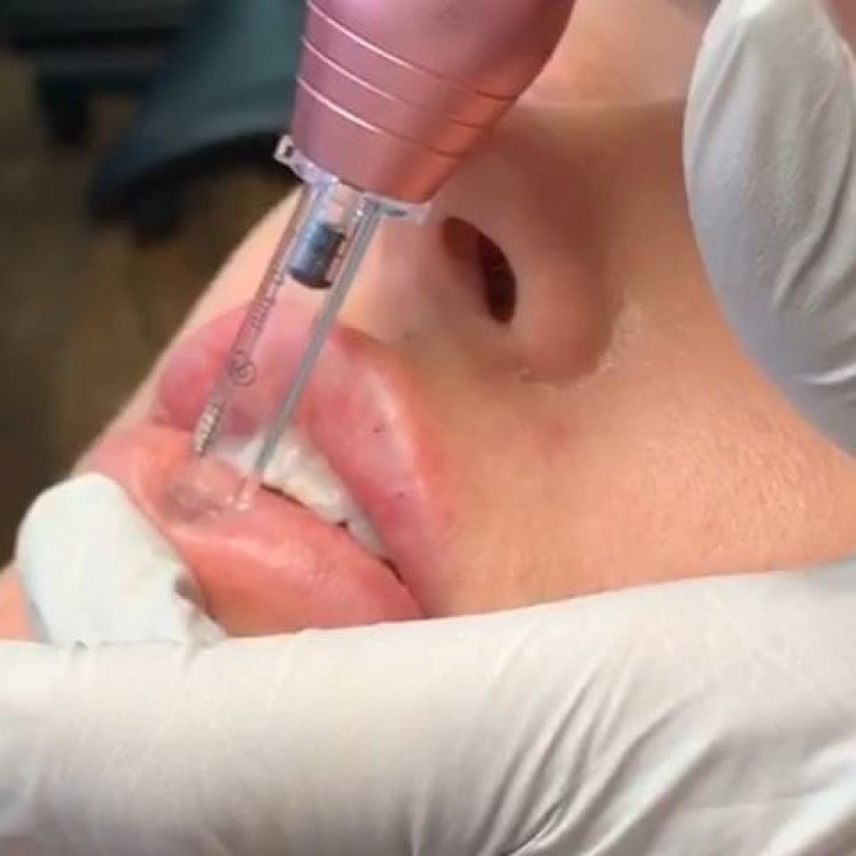 Hyaluron pen à Rueil-Malmaison (92) Par Sandrine - Estheca
