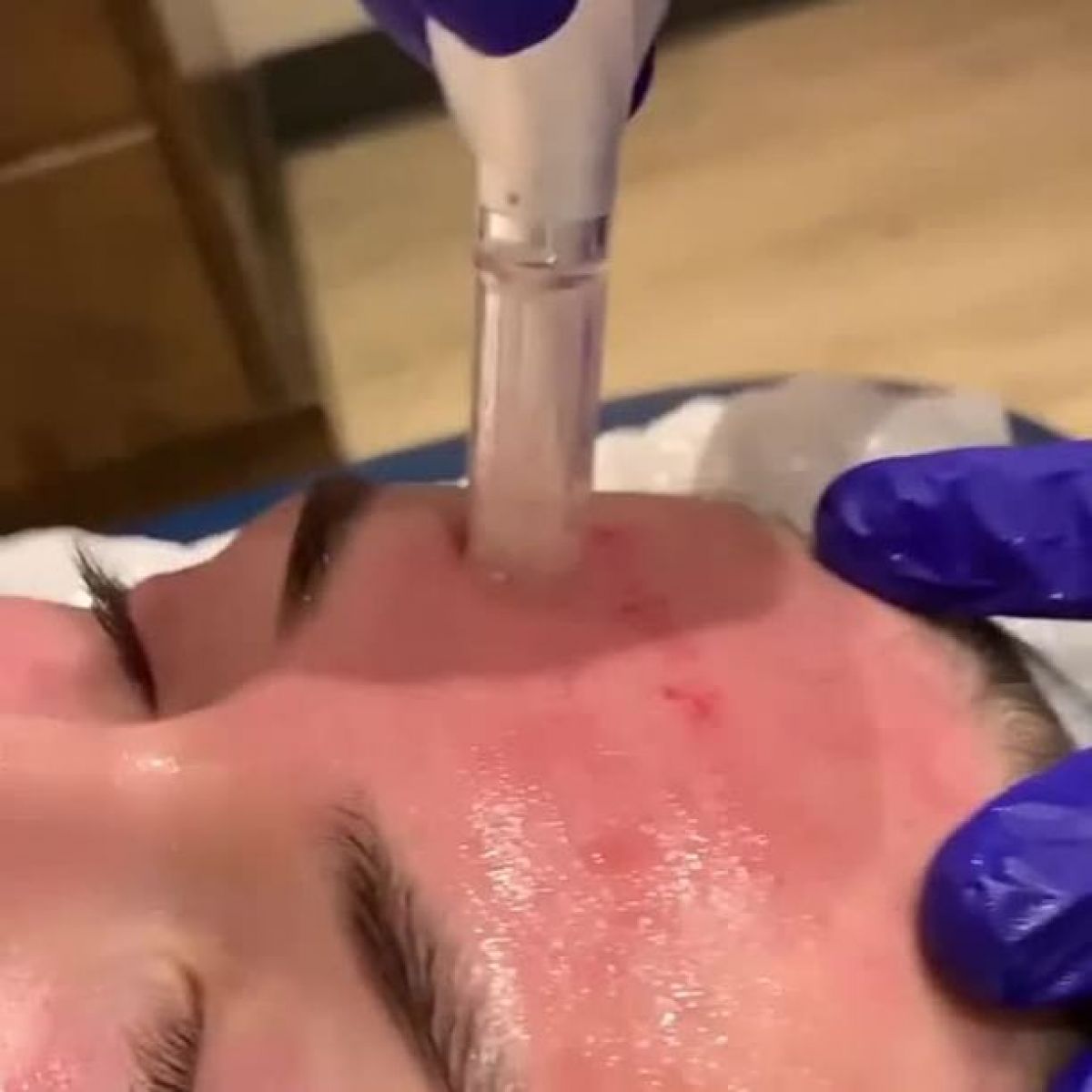 MicroNeedling BB Glow à Mouscron Par Inès - Estheca