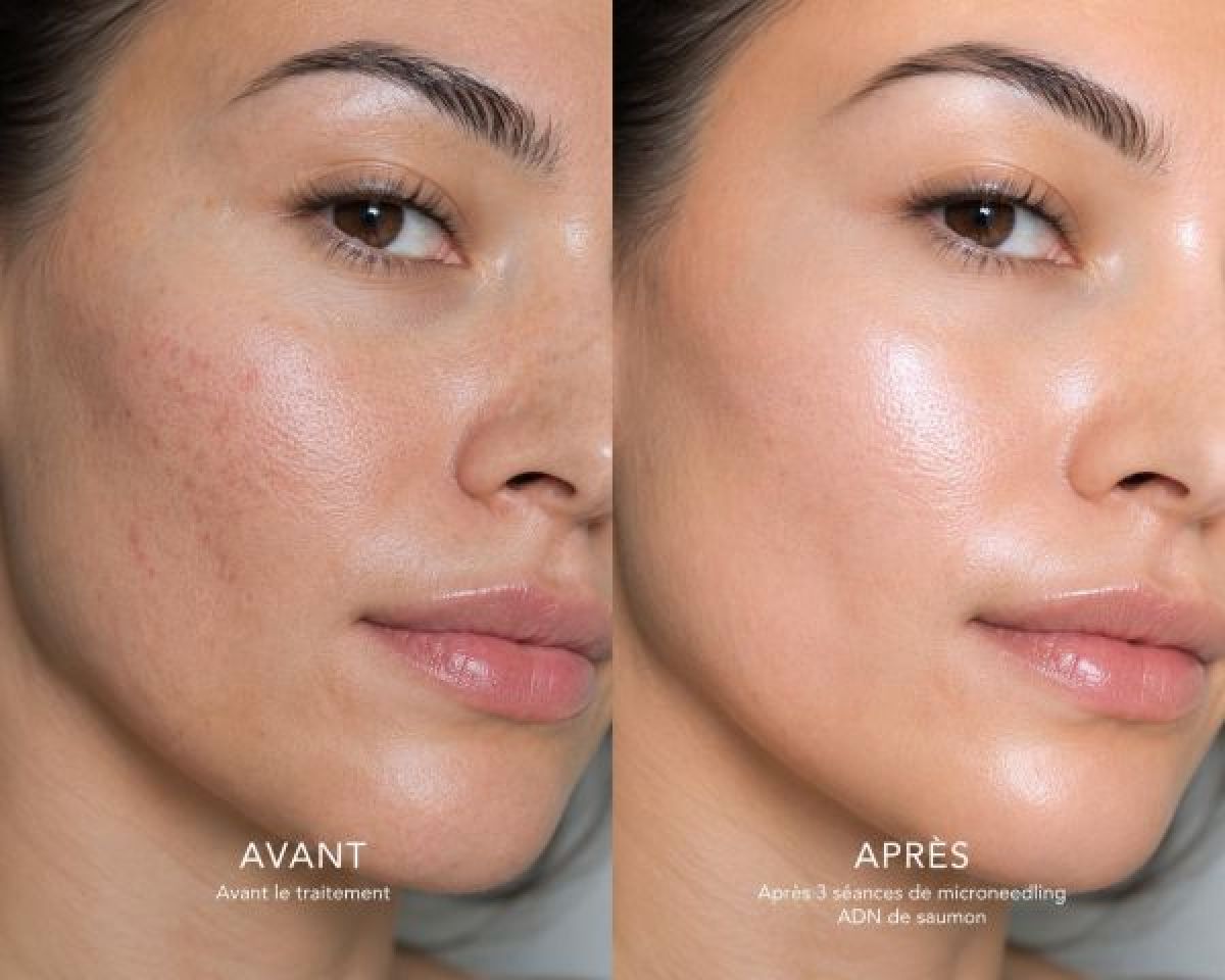 Microneedling à Lattes (34) Par Fayna - Estheca