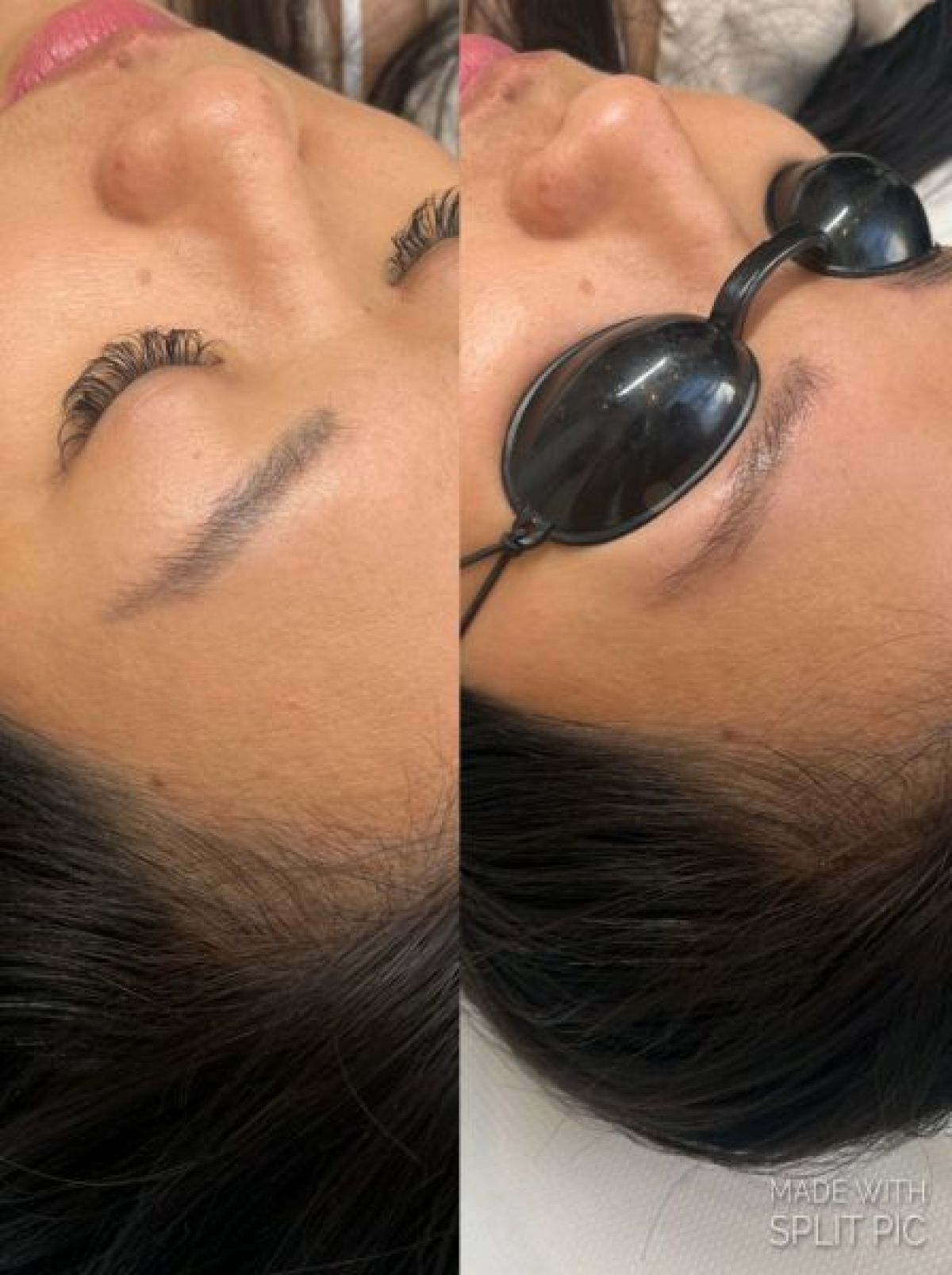 Détatouage à La Valette-du-Var (83) Par Morgane - Estheca