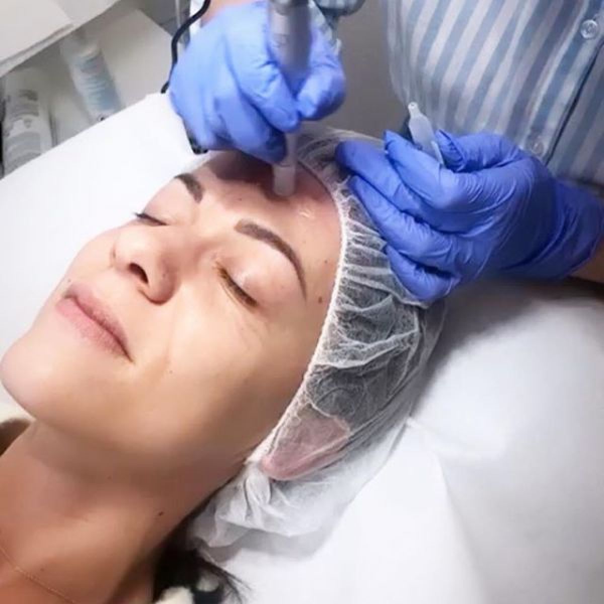 MicroNeedling BB Glow à Ivry-sur-Seine (94) Par Wafa - Estheca