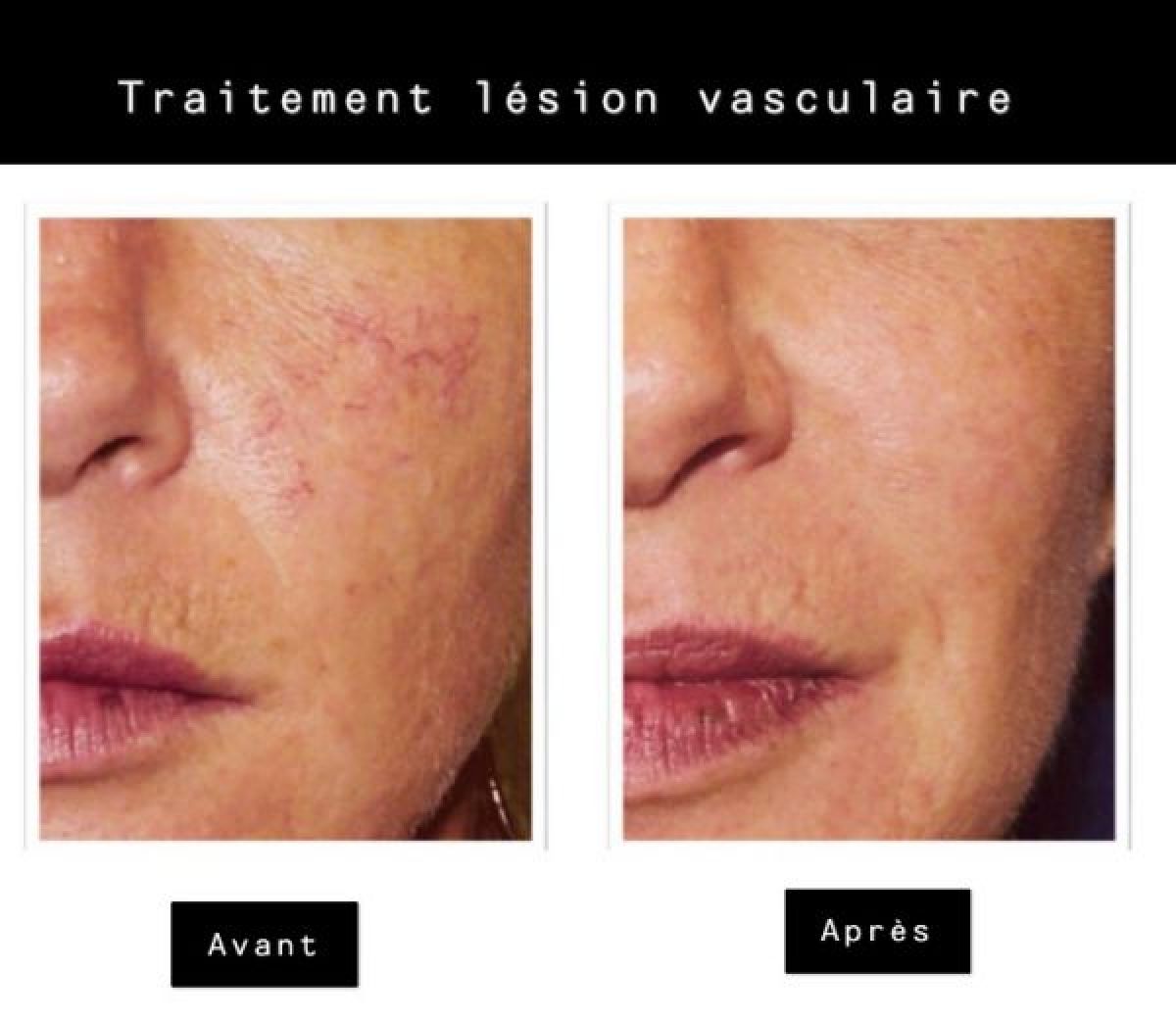 Traitement des lésions par Laser à Tourcoing (59) Par Anne-Charlotte - Estheca