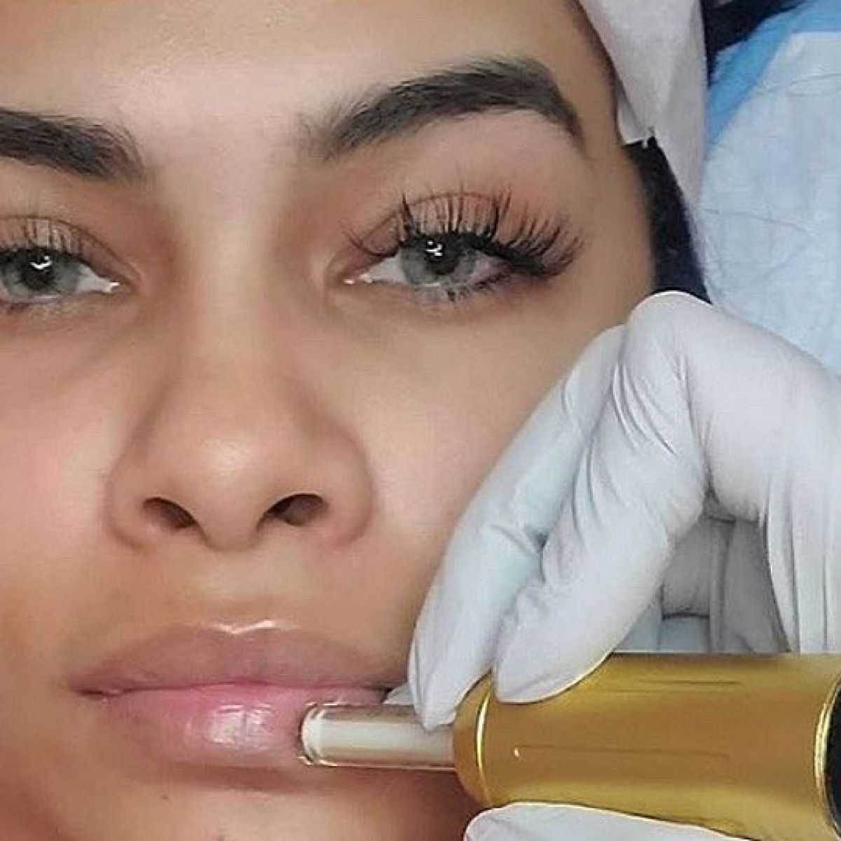 Augmentation lèvres Hyaluron pen à Challes-les-Eaux (73) Par Rachida - Estheca