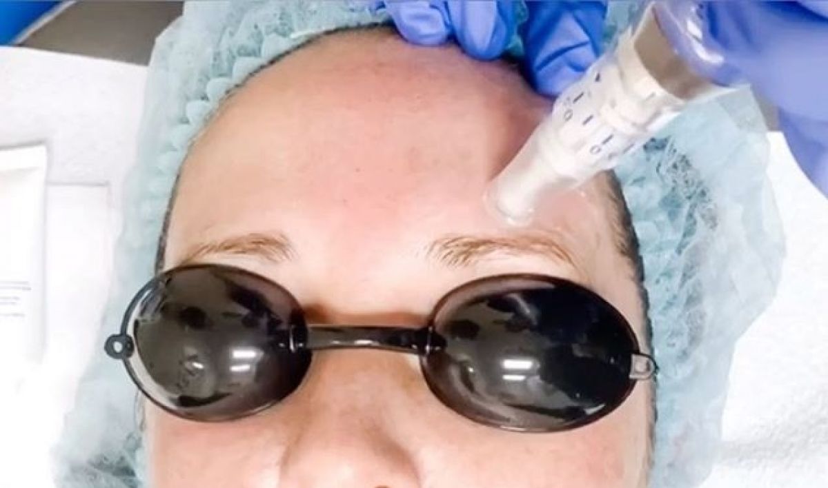 MicroNeedling BB Glow à Villeneuve-lès-Avignon (30) Par Océane - Estheca