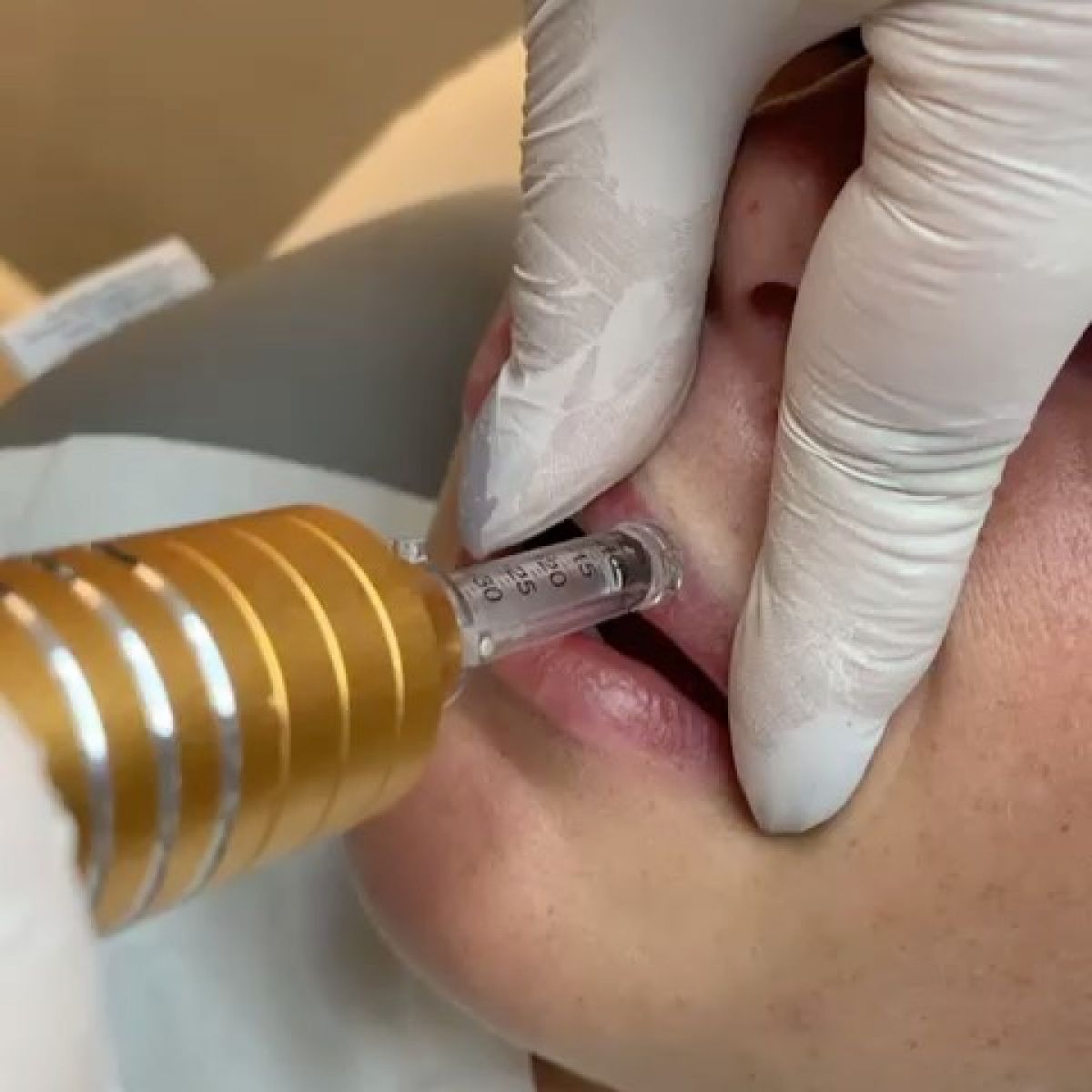 Augmentation lèvres Hyaluron pen à Saint-Herblain (44) Par Mélissa - Estheca