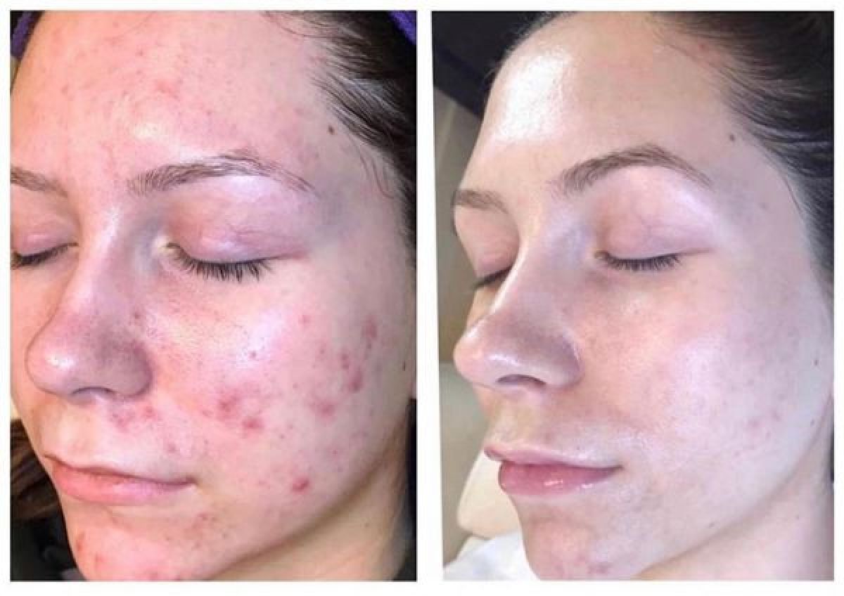 Microneedling / BB GLOW à Béthune (62) Par Magda - Estheca