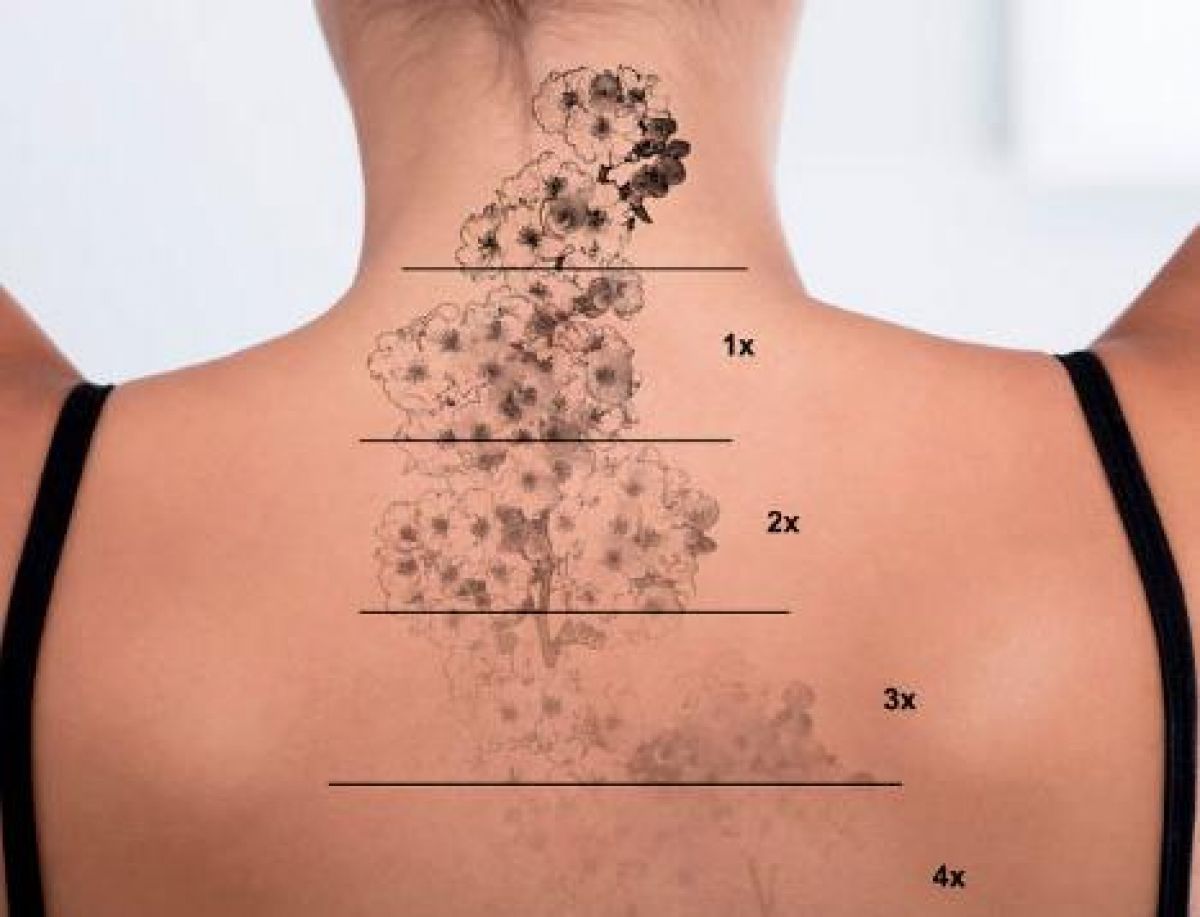 Détatouage NanoRemoval à Béziers (34) Par Marina - Estheca