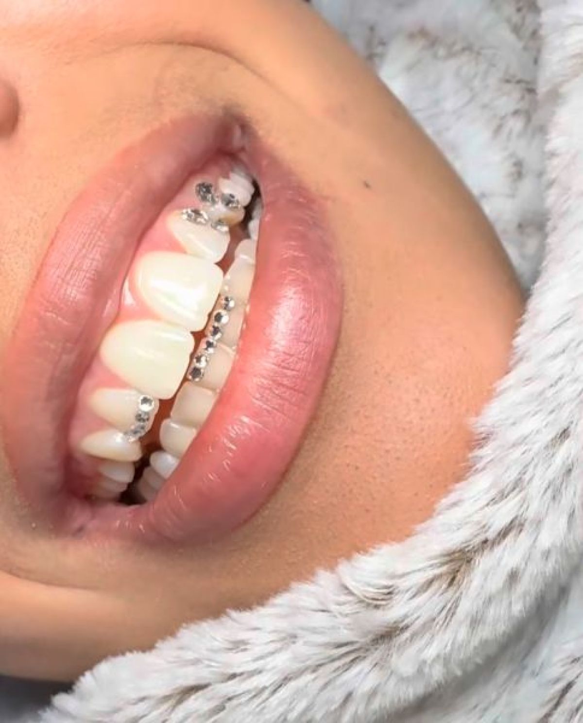 Strass dentaire à Pontault-Combault (77) Par Camila - Estheca