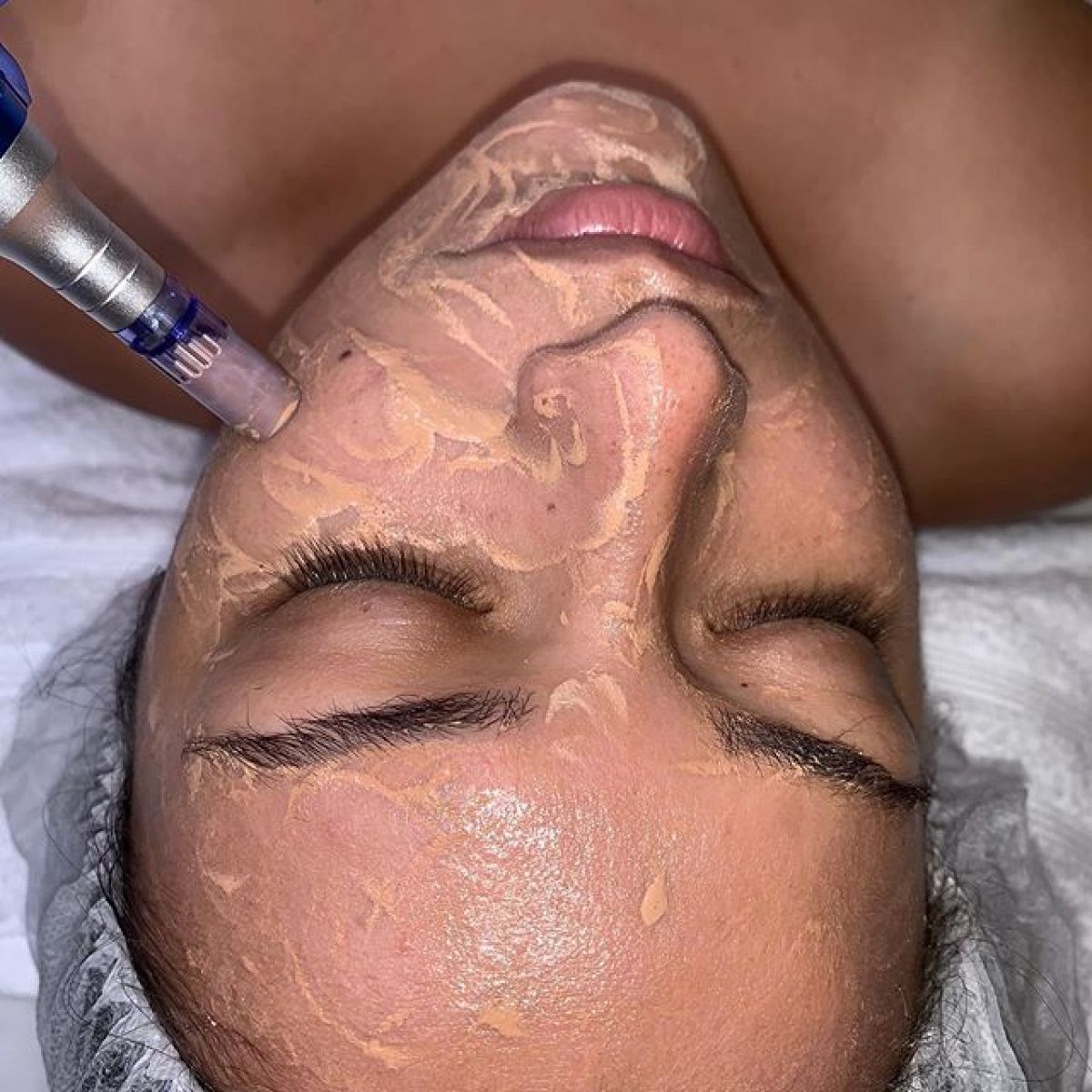 MicroNeedling BB Glow à Wasquehal (59) Par Maeva - Estheca