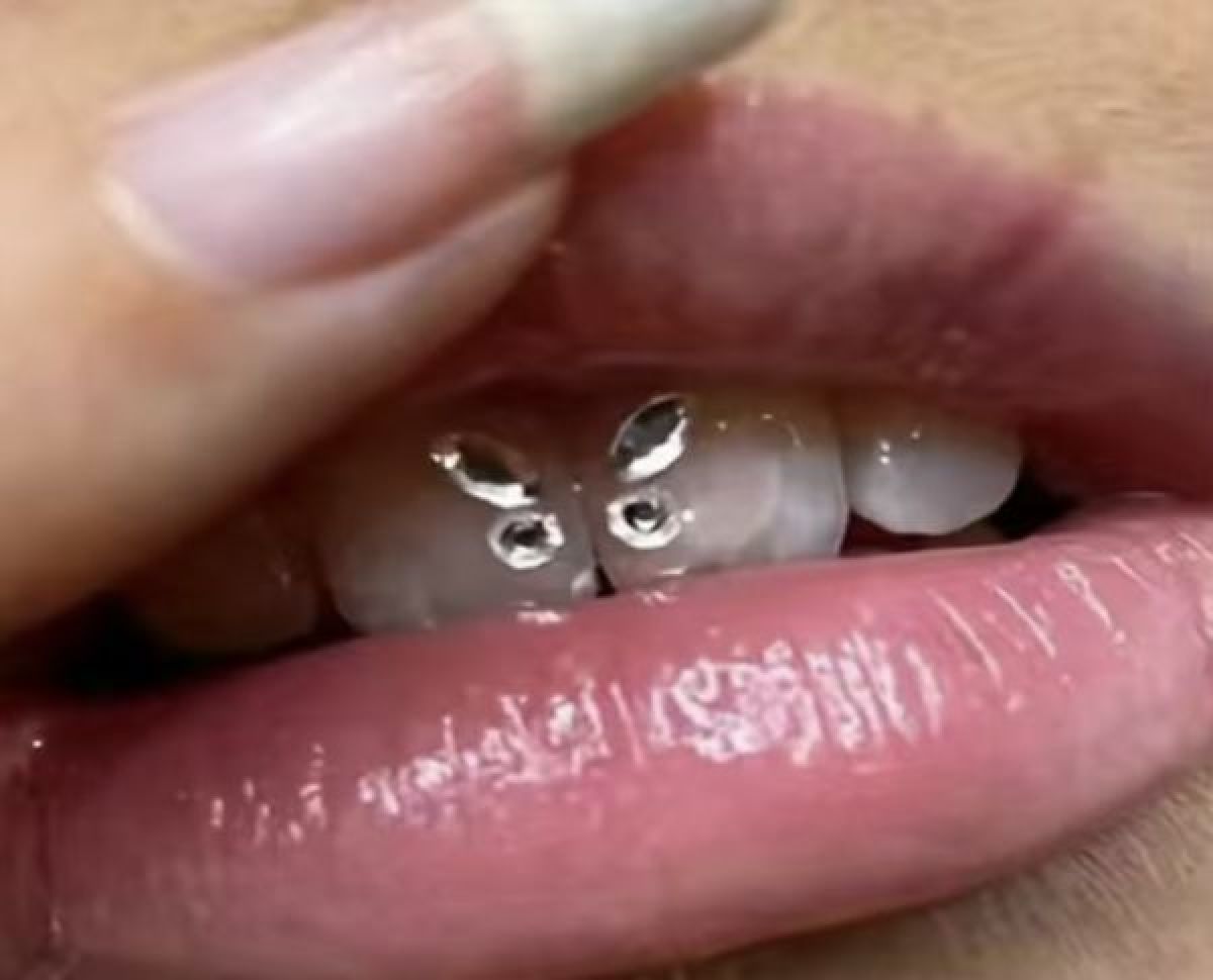 Strass dentaire à Écully (69) Par Kenza - Estheca