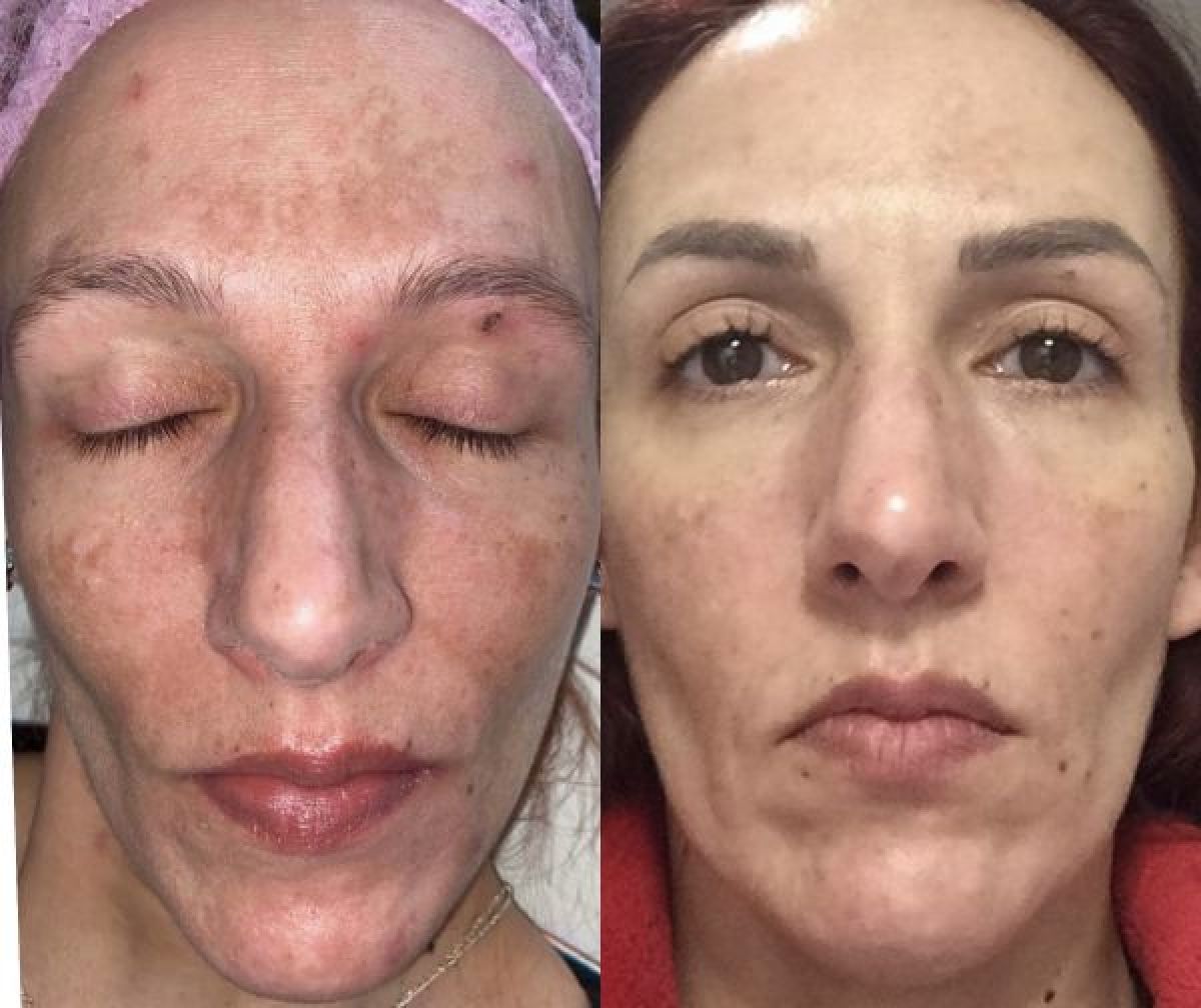 Peeling végétal Zena  à Carvin (62) Par Gwendoline - Estheca