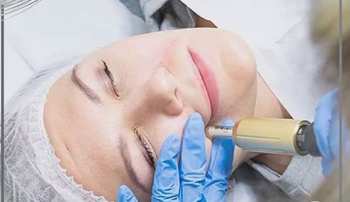 Hyaluron pen à Saint-Raphaël (83) Par Mélissa - Estheca
