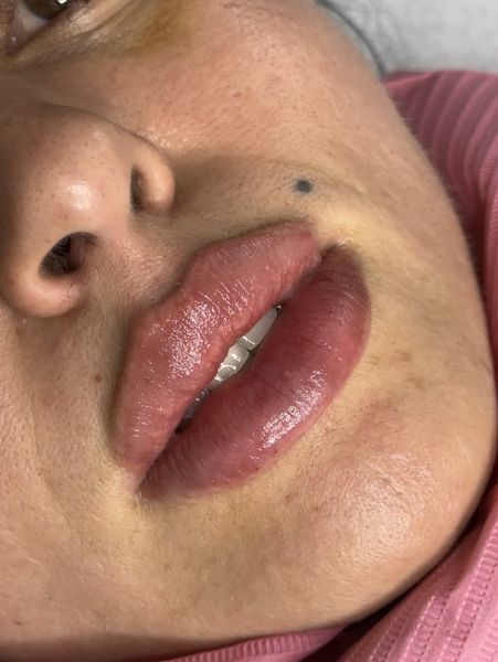 À Noisy-le-Grand | Russian lips / augmentation des lèvres / comblement des ride | Les meilleures esthéticiennes