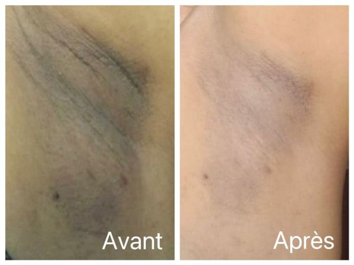 Éclaircissement des zones intimes et du corps à Voiron (38) Par Marcela - Estheca