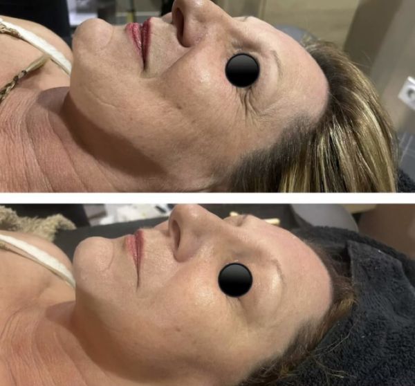 À Cranves-Sales | HIFU Lifting sans chirurgie | Les meilleures esthéticiennes