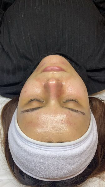 À Guénange | Hydrafacial | Les meilleures esthéticiennes