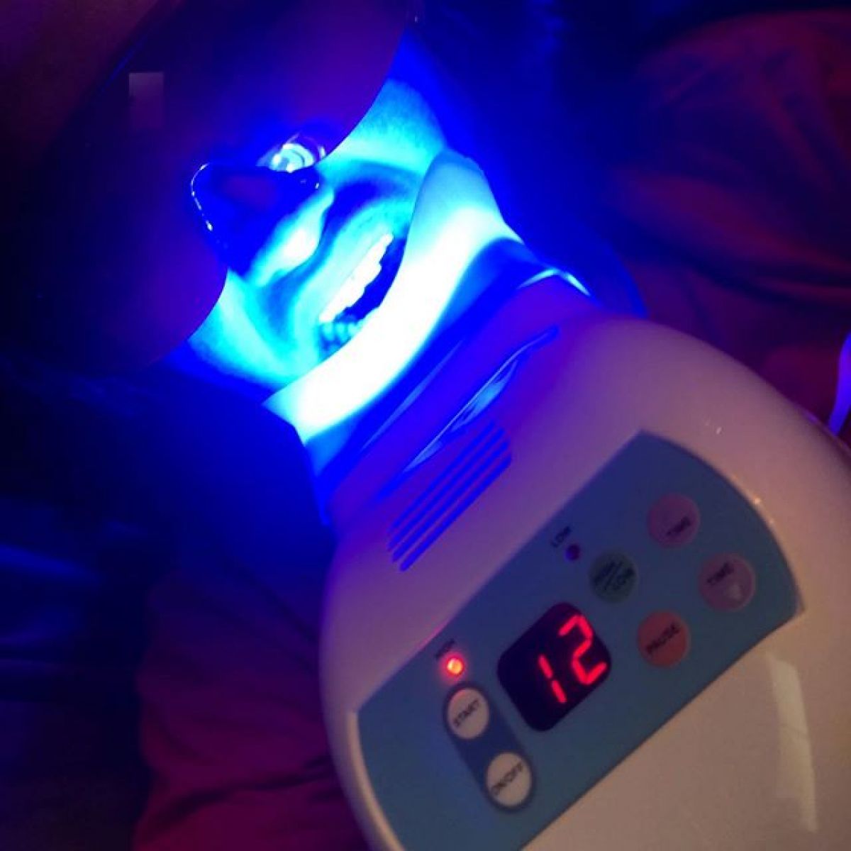 Blanchiment dentaire à Nantes (44) Par Sabrina - Estheca