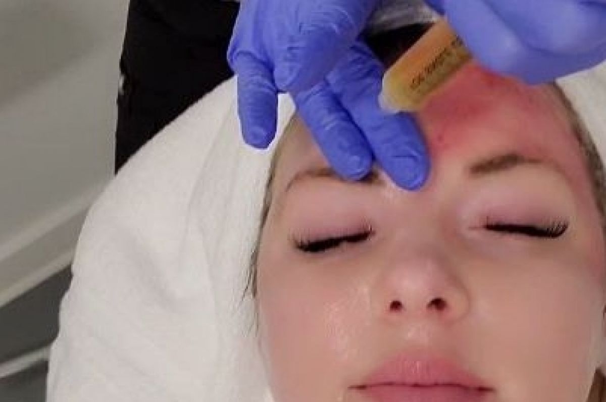 MicroNeedling BB Glow à Lèves (28) Par Angélique - Estheca