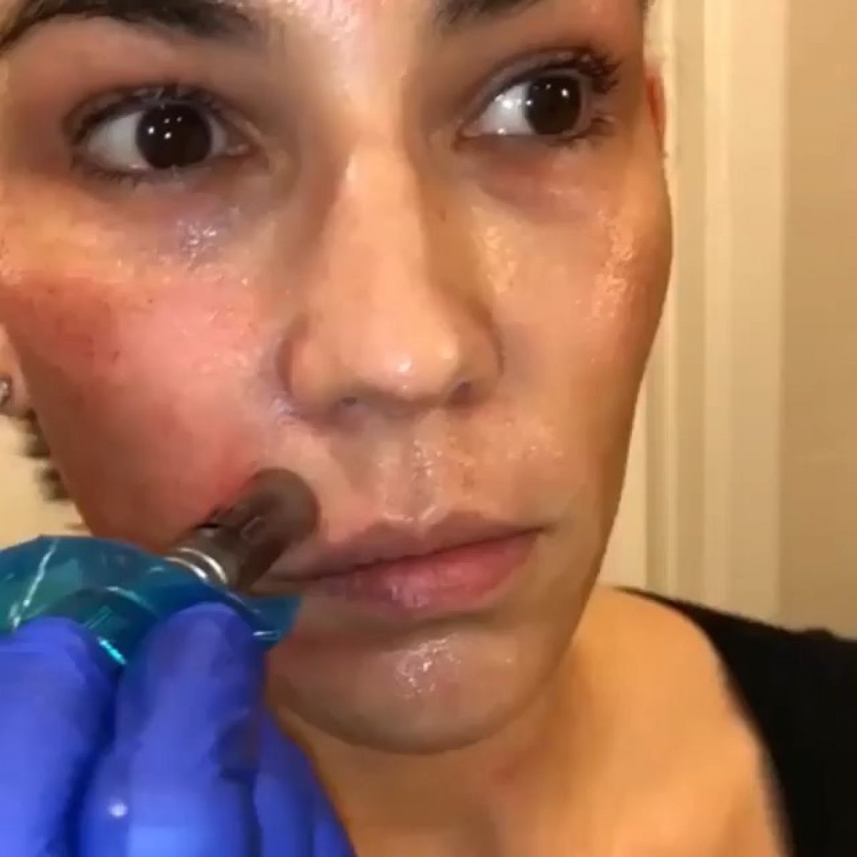 MicroNeedling BB Glow à Cugnaux (31) Par Angélique - Estheca