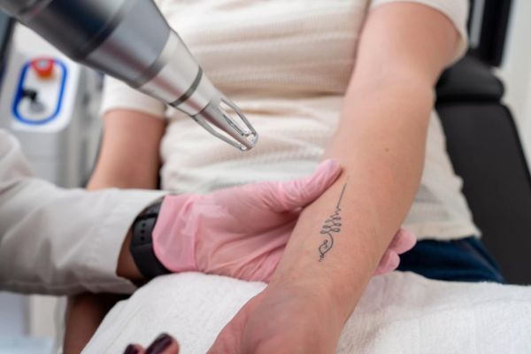 À Bordeaux | Détatouage laser | Les meilleures esthéticiennes