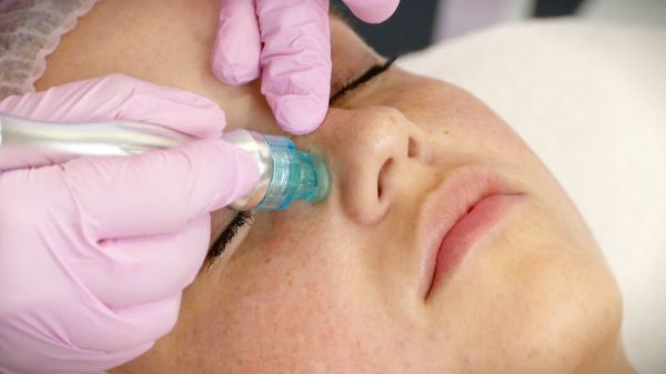 À Lille | Hydrafacial (points noirs, acné...etc) | Les meilleures esthéticiennes