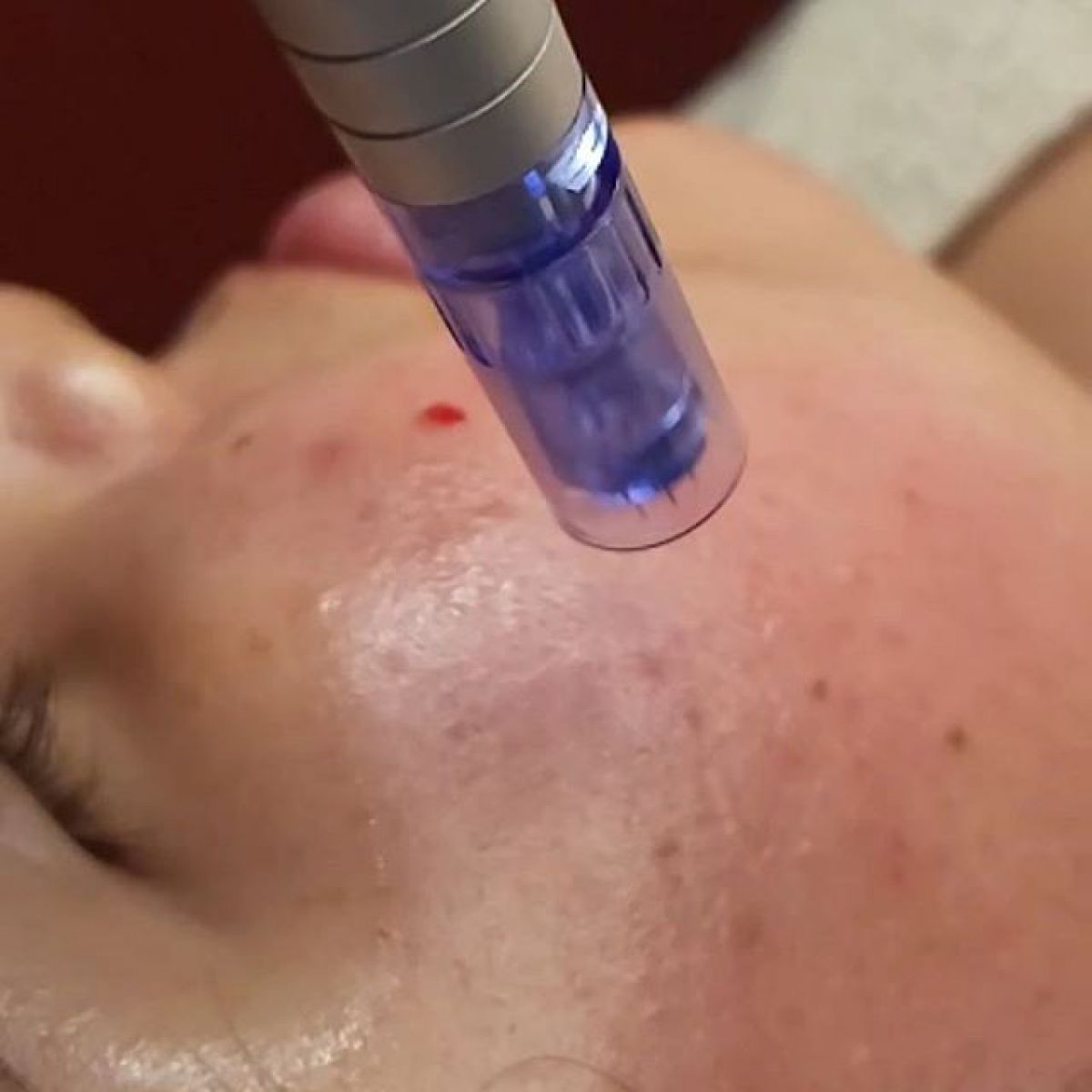 MicroNeedling BB Glow à Lingolsheim (67) Par Camille - Estheca