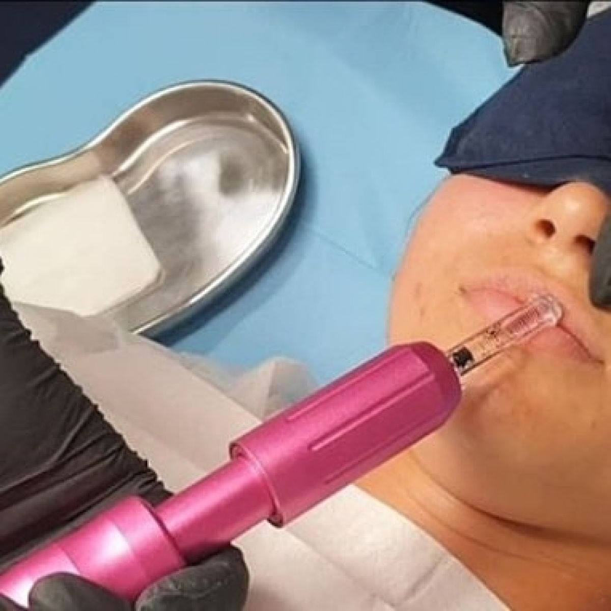 Augmentation lèvres Hyaluron pen à Plaintel (22) Par Charlotte - Estheca