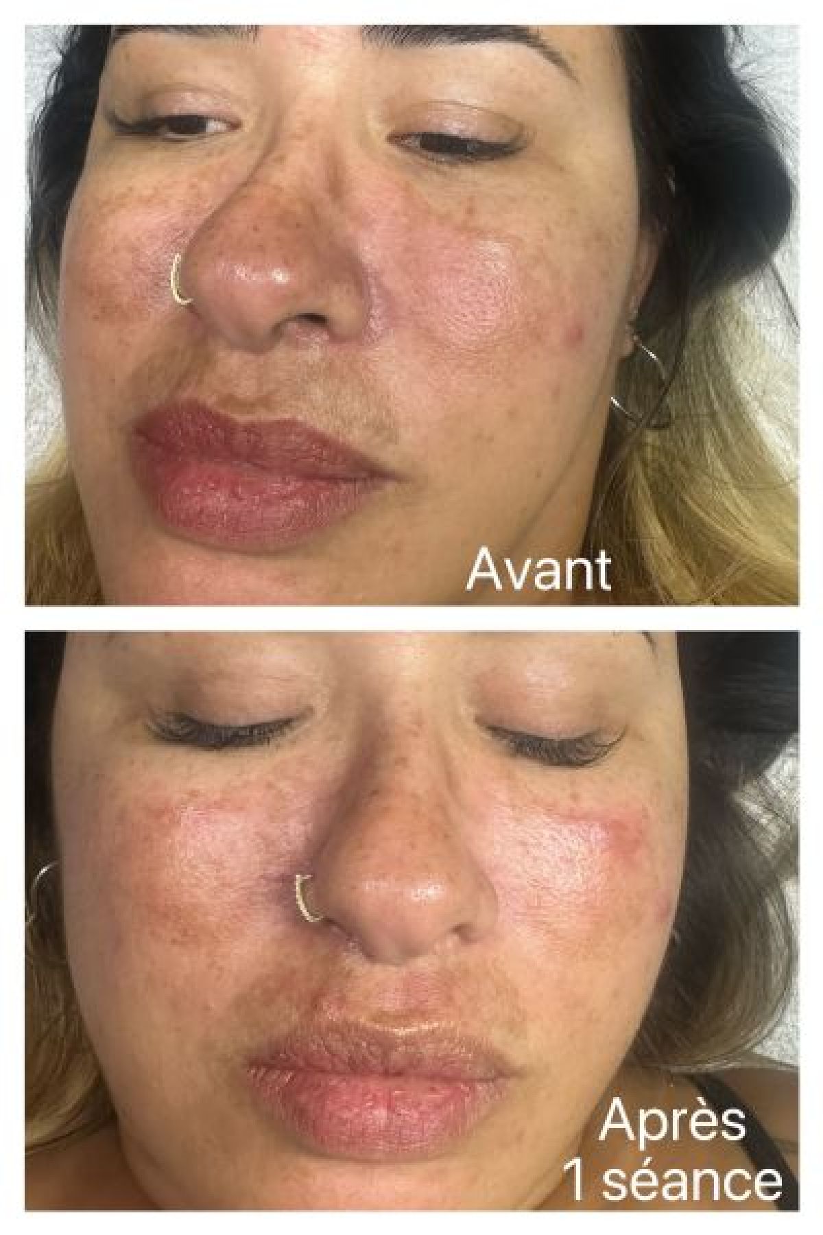Traitement du Mélasma à Voiron (38) Par Marcela - Estheca