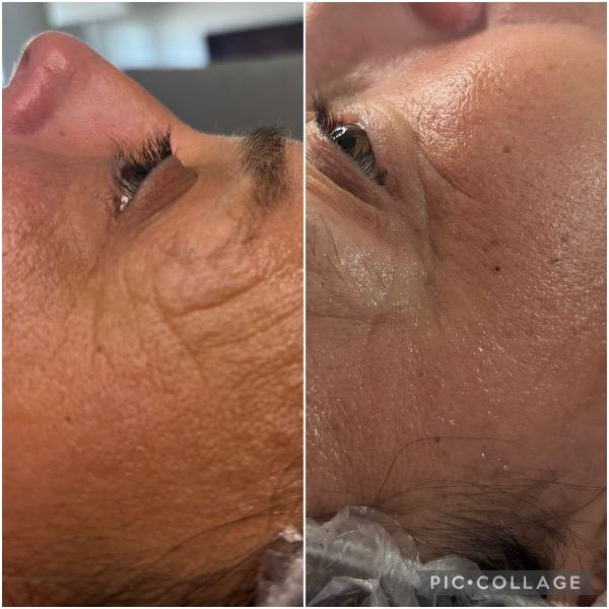 Lifting coréen  à Dijon (21) Par Charlotte - Estheca