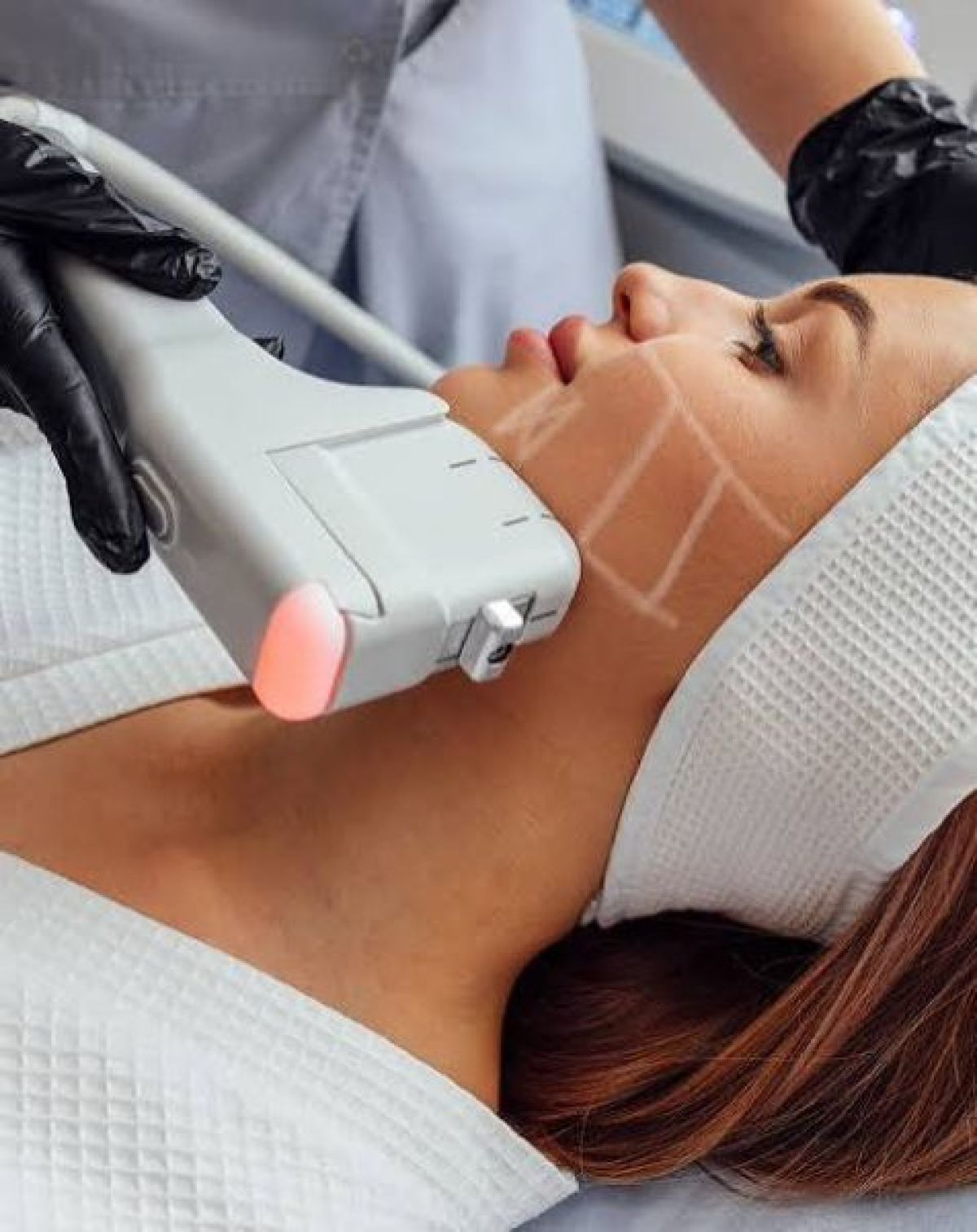 Hifu lifting à Guénange (57) Par Magalie - Estheca